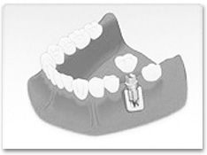 インプラント施術図