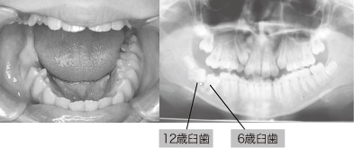 6歳臼歯と12歳臼歯